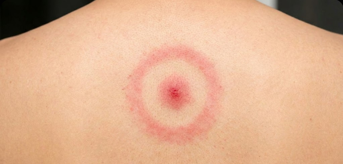 עקיצת קרציה