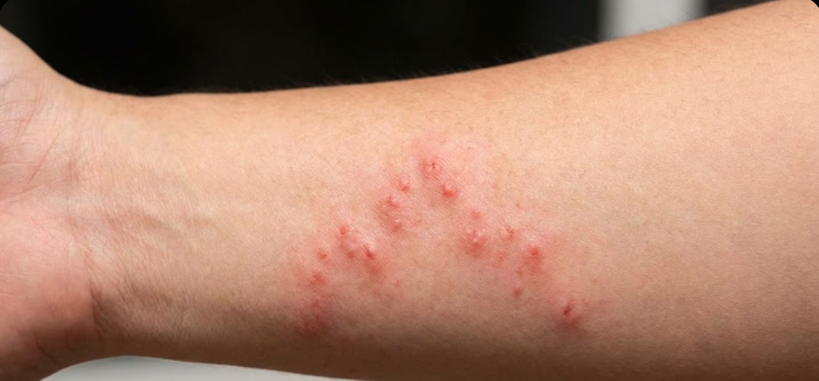 עקיצות פשפש המיטה